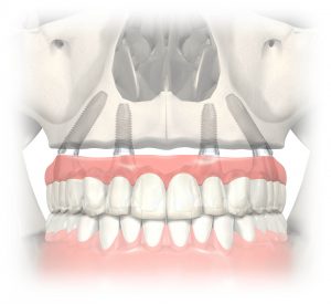 all on 4 teeth in a day dental implants oral dental surgery