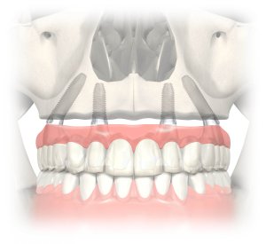 all on 4 teeth in a day dental implants oral dental surgery